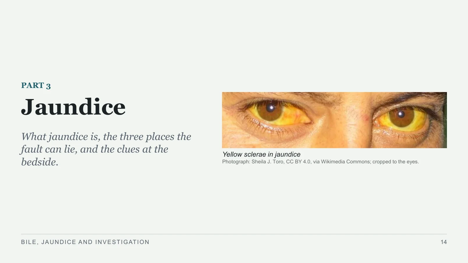 Slide 14: Jaundice