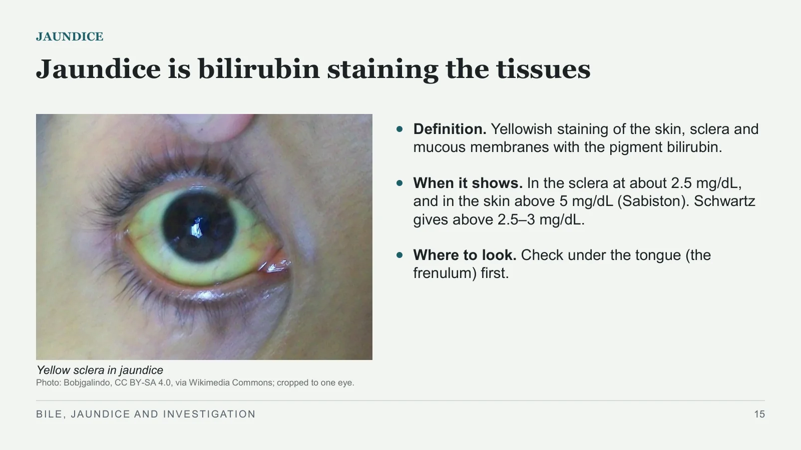 Slide 15: Jaundice is bilirubin staining the tissues