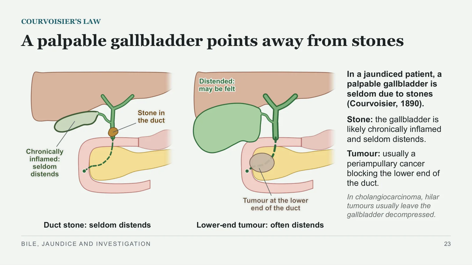 Slide 23: A palpable gallbladder points away from stones