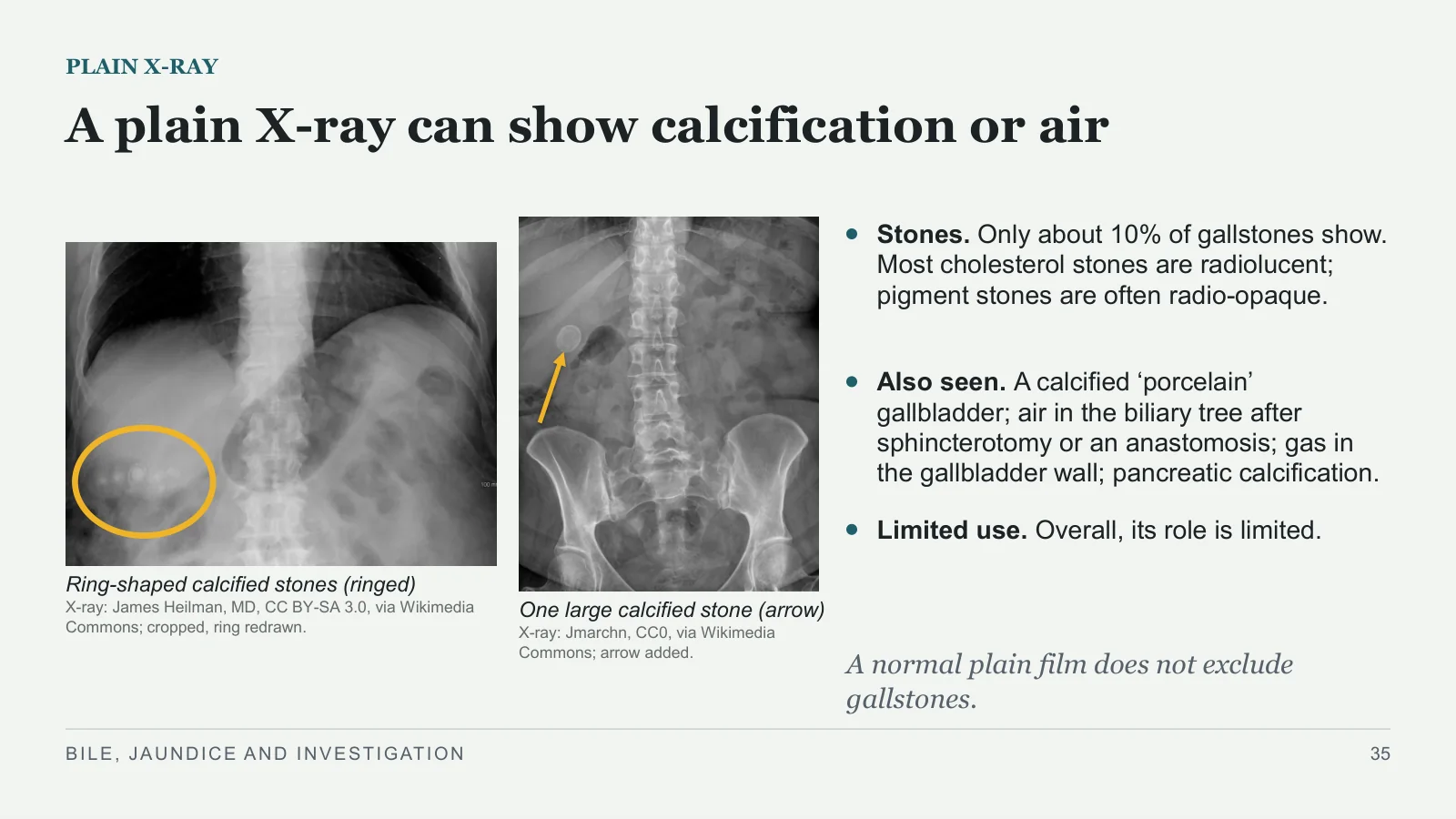 Slide 35: A plain X-ray can show calcification or air