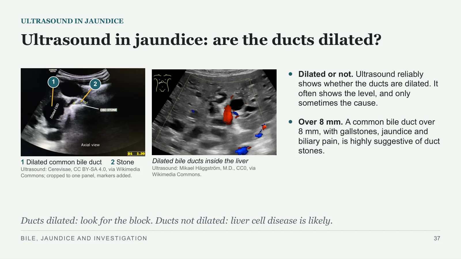 Slide 37: Ultrasound in jaundice: are the ducts dilated?