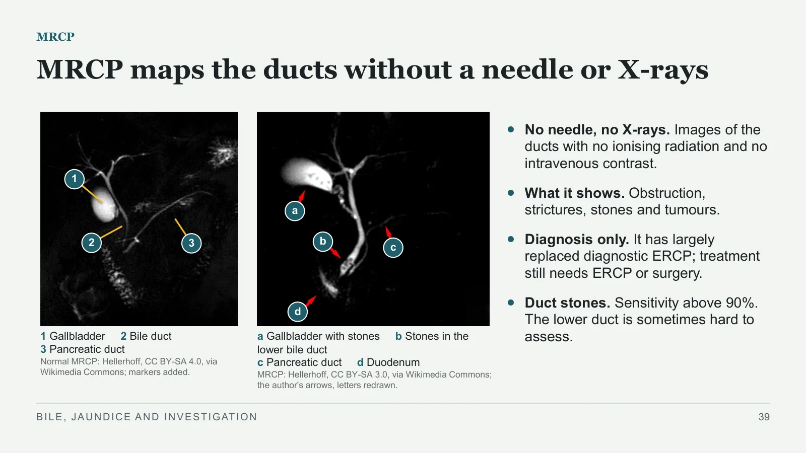 Slide 39: MRCP maps the ducts without a needle or X-rays
