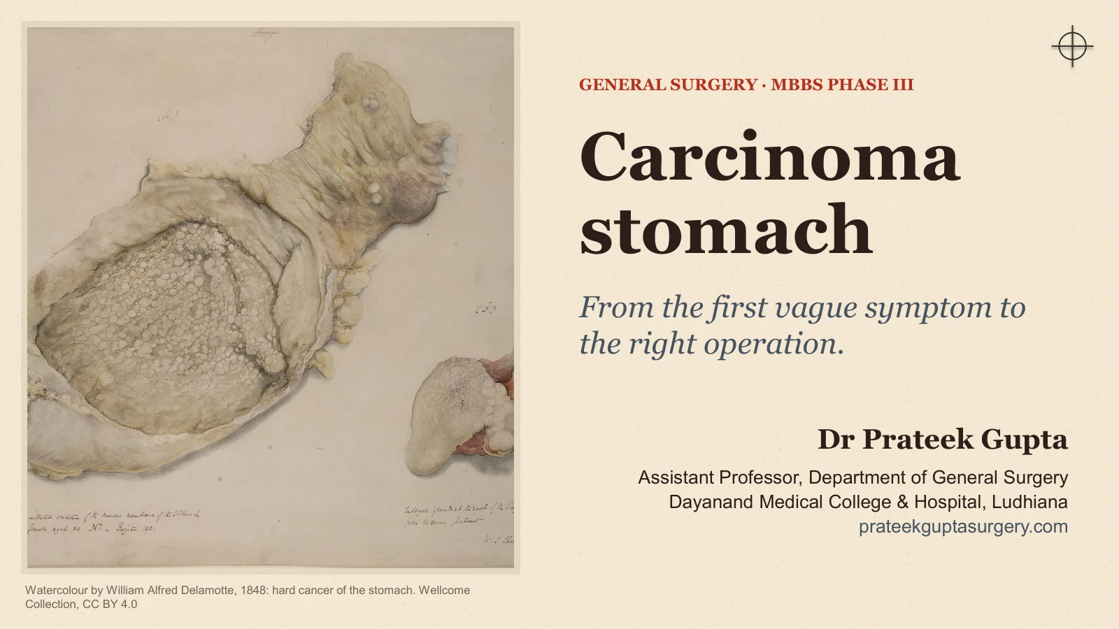 Slide 1: Carcinoma Stomach