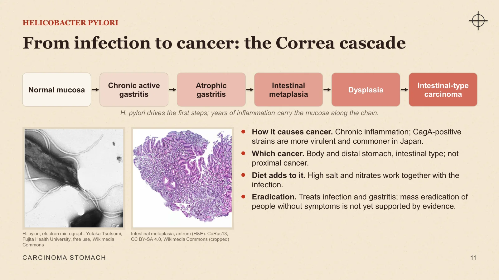 Slide 11: From infection to cancer: the Correa cascade
