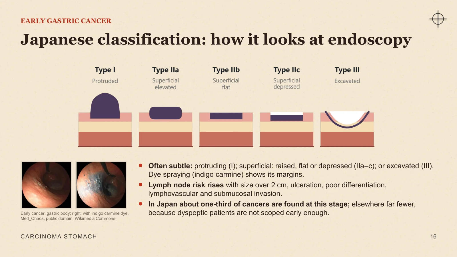 Slide 16: Japanese classification: how it looks at endoscopy