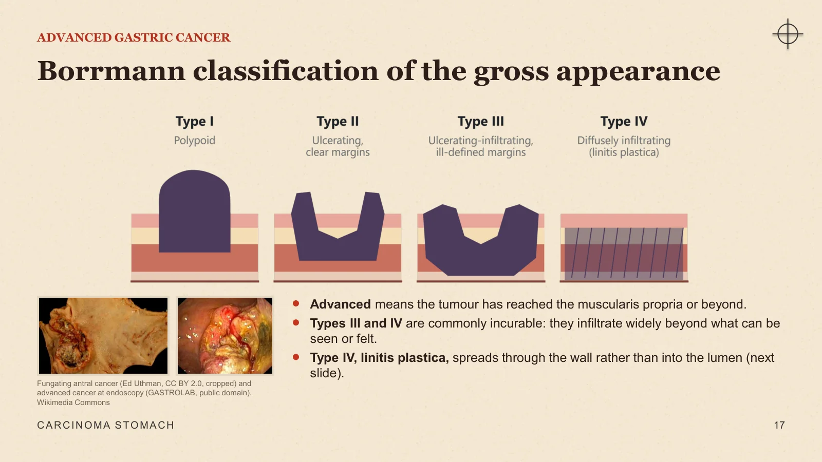 Slide 17: Borrmann classification of the gross appearance
