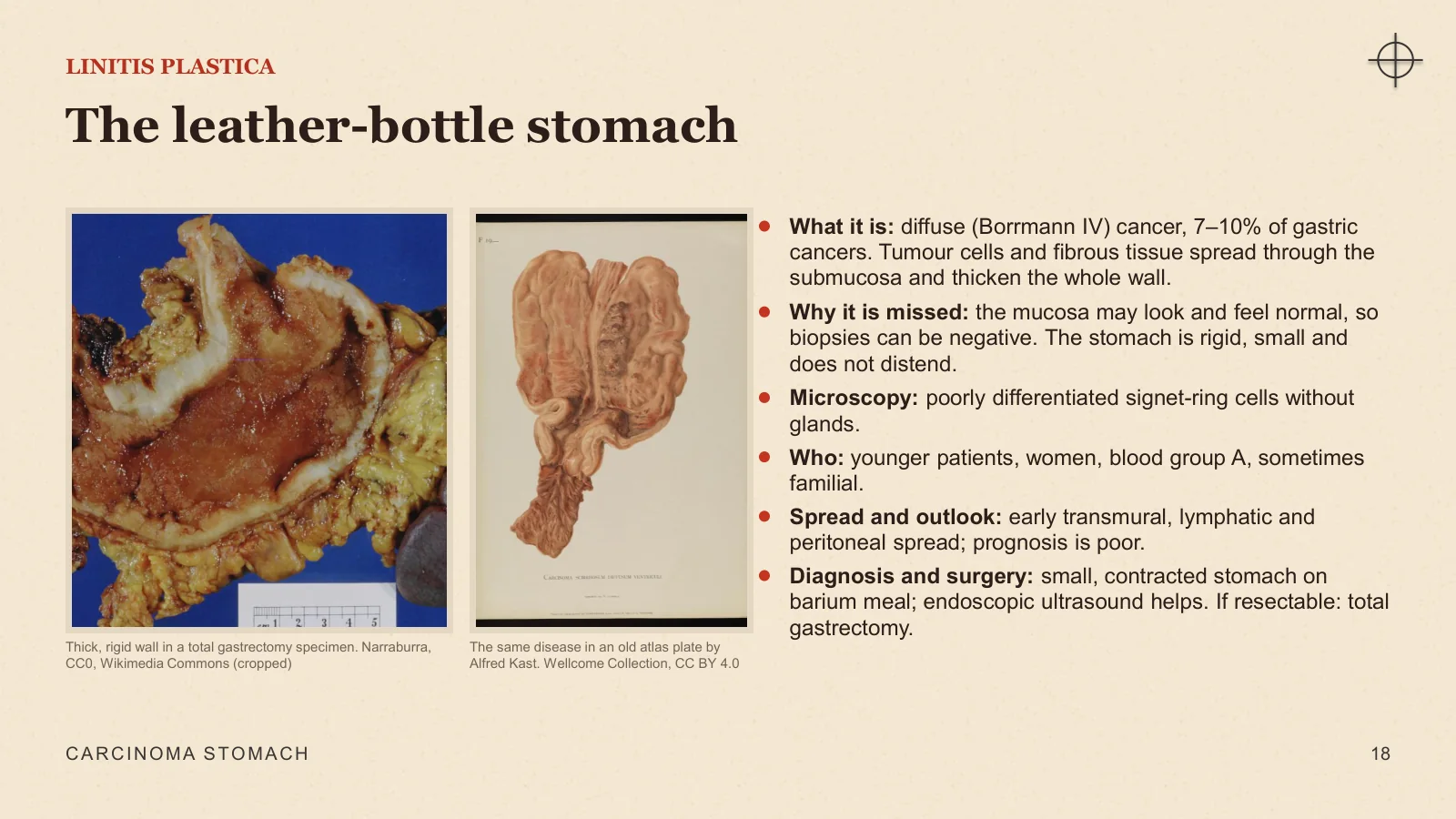 Slide 18: The leather-bottle stomach