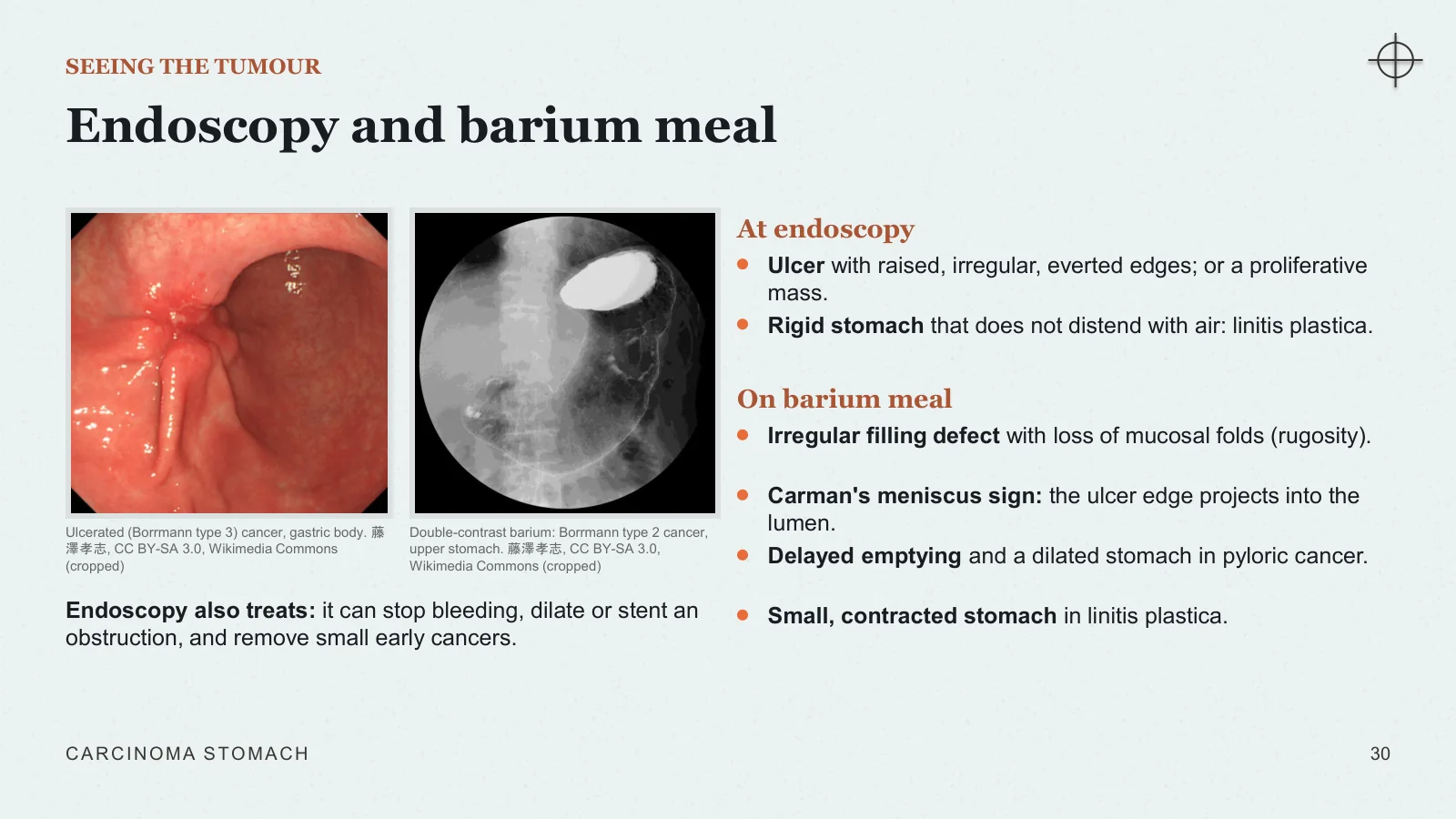 Slide 30: Endoscopy and barium meal