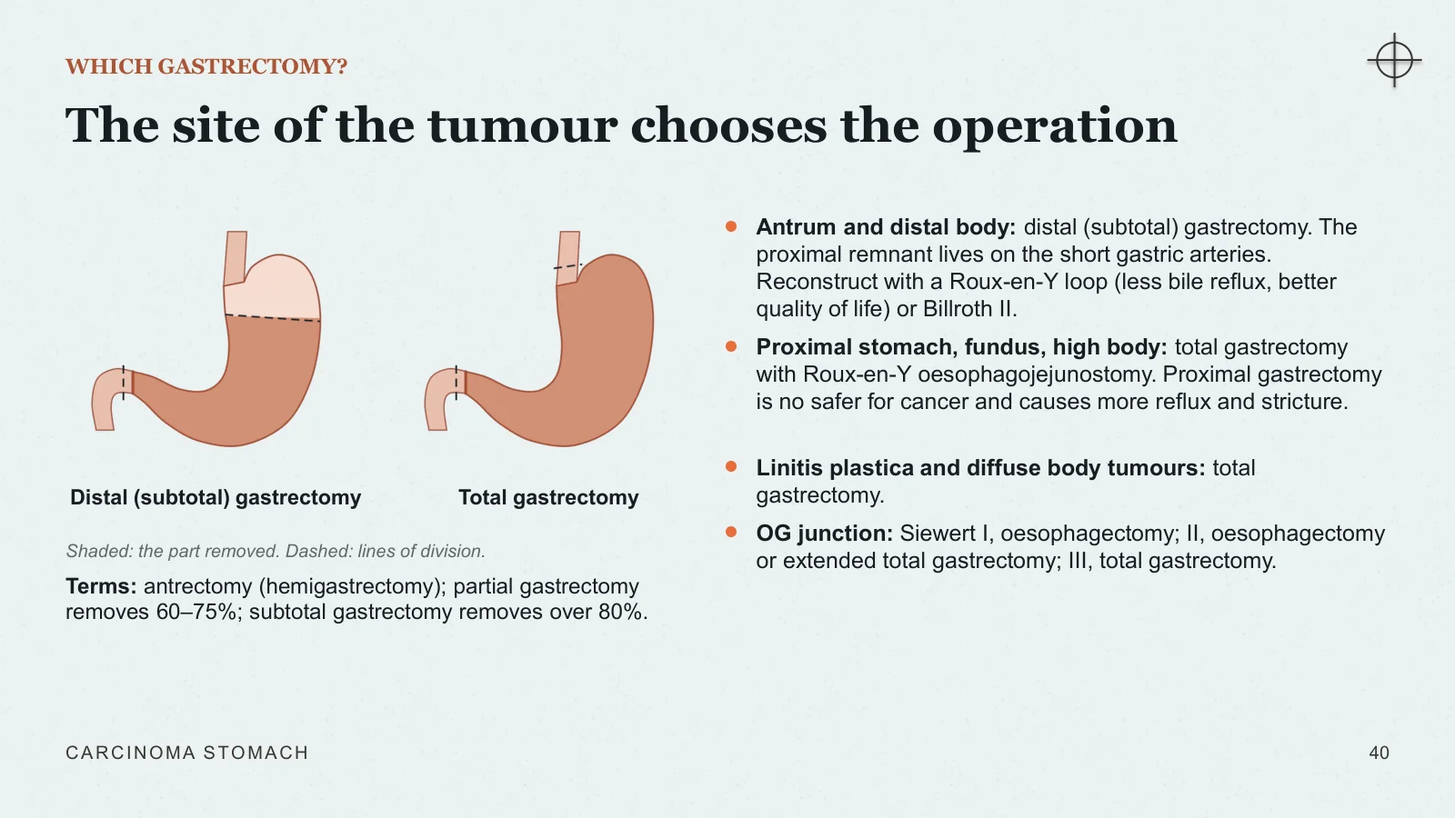 Slide 40: The site of the tumour chooses the operation