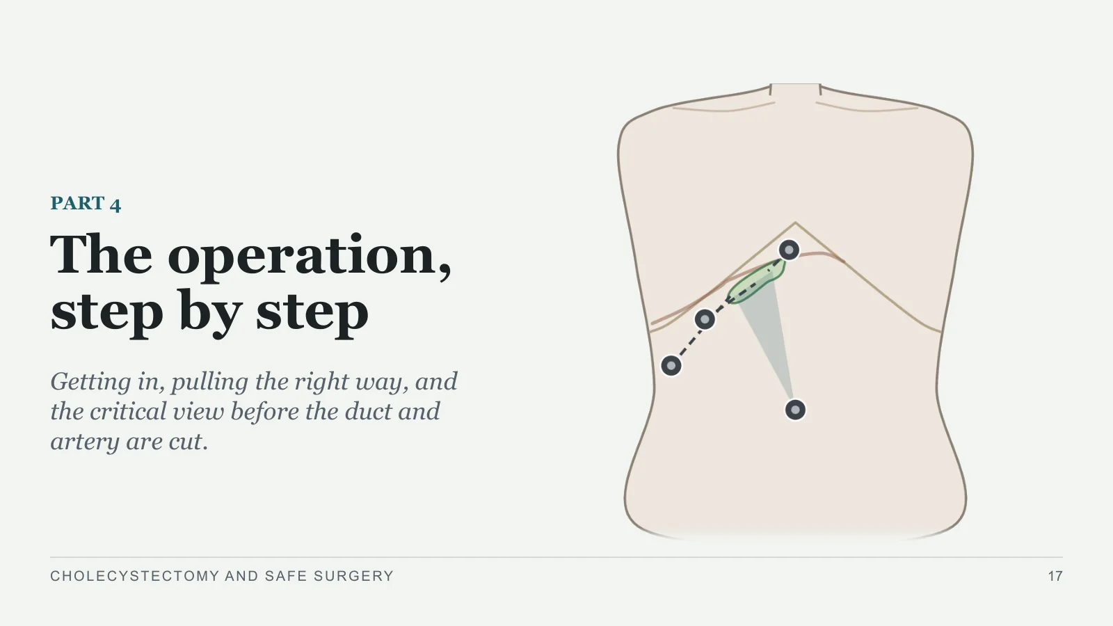 Slide 17: The operation, step by step