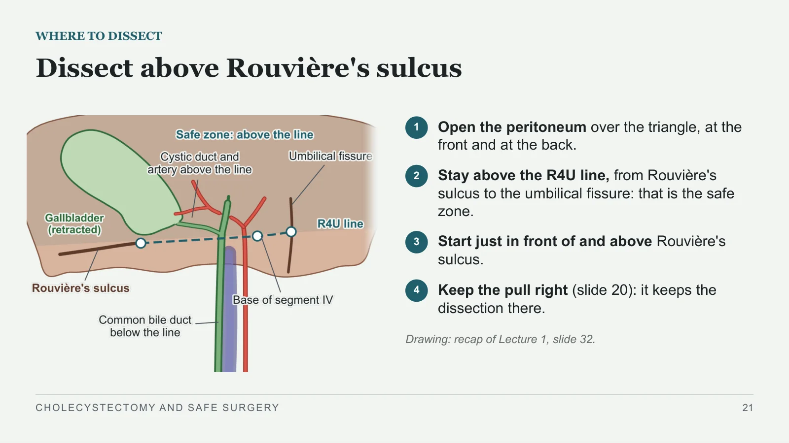 Slide 21: Dissect above Rouvière's sulcus