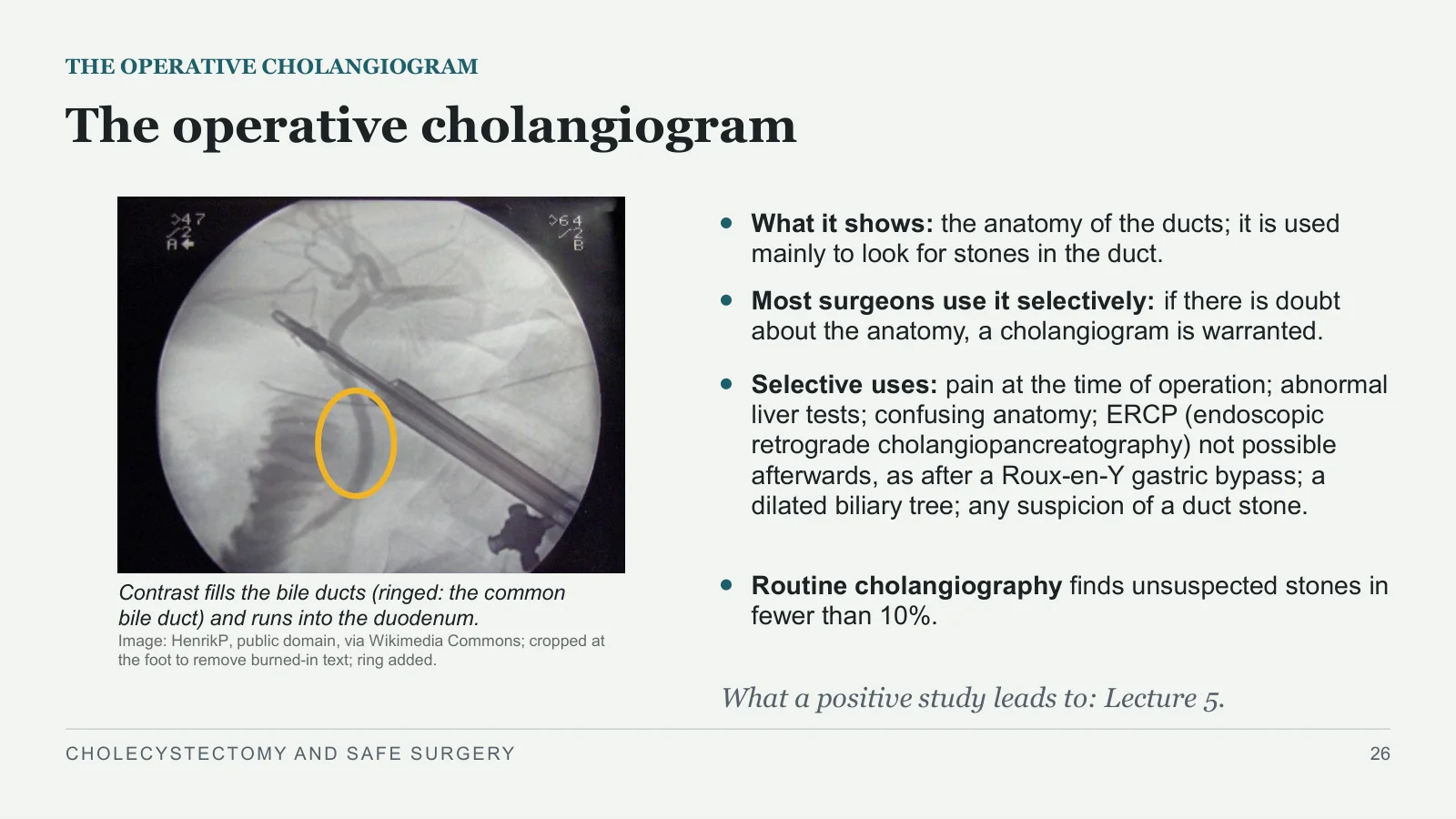 Slide 26: The operative cholangiogram