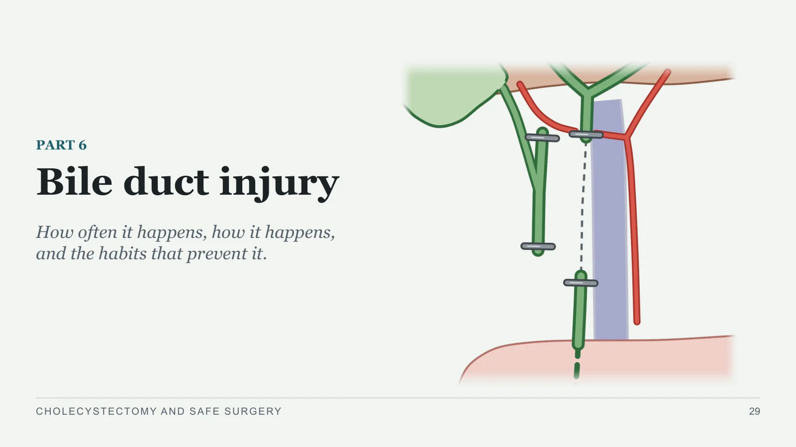 Slide 29: Bile duct injury