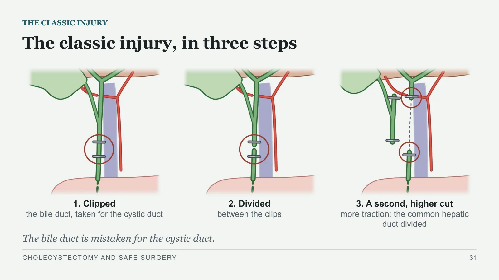 Slide 31: The classic injury, in three steps