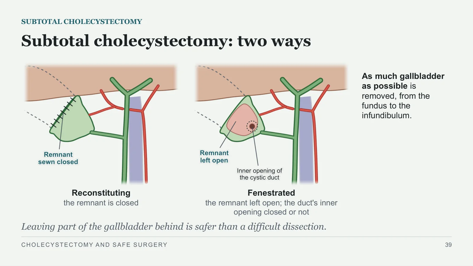 Slide 39: Subtotal cholecystectomy: two ways