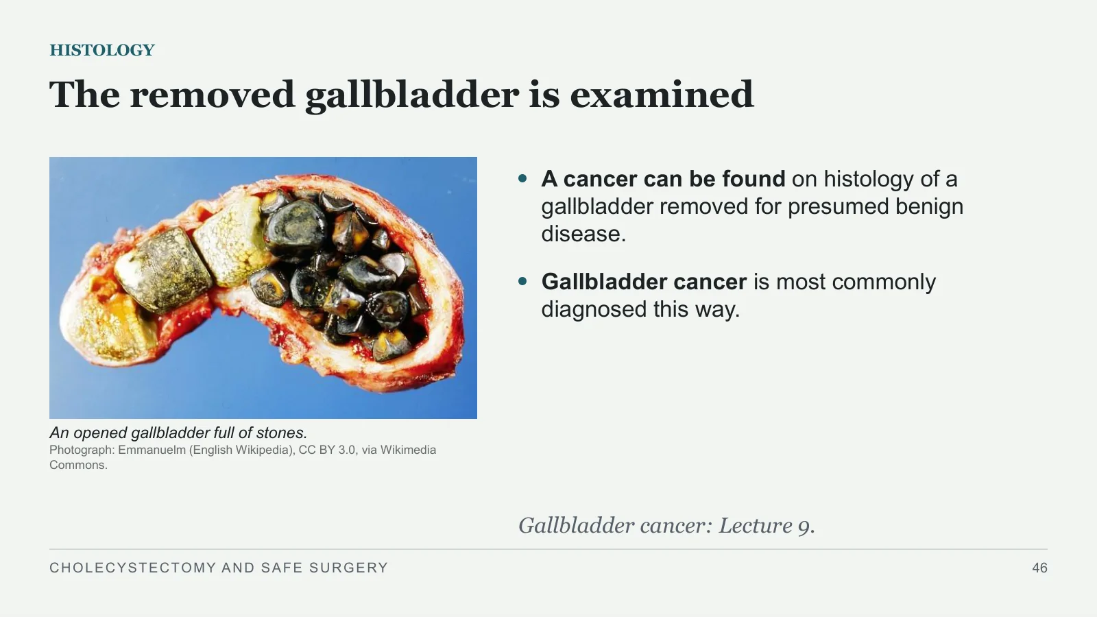 Slide 46: The removed gallbladder is examined