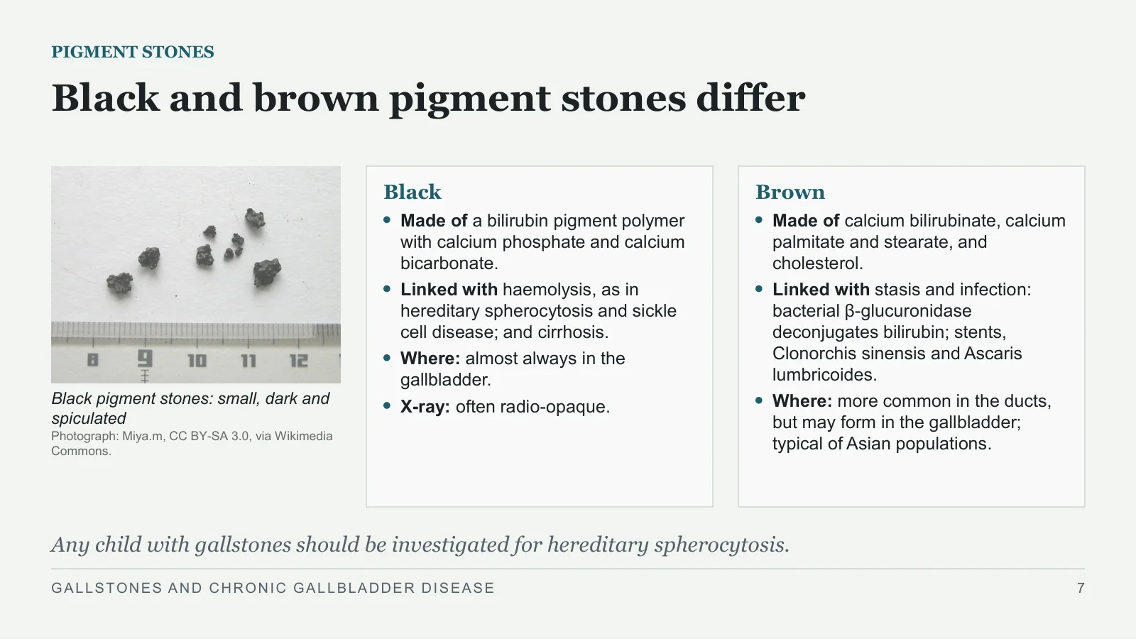 Slide 7: Black and brown pigment stones differ