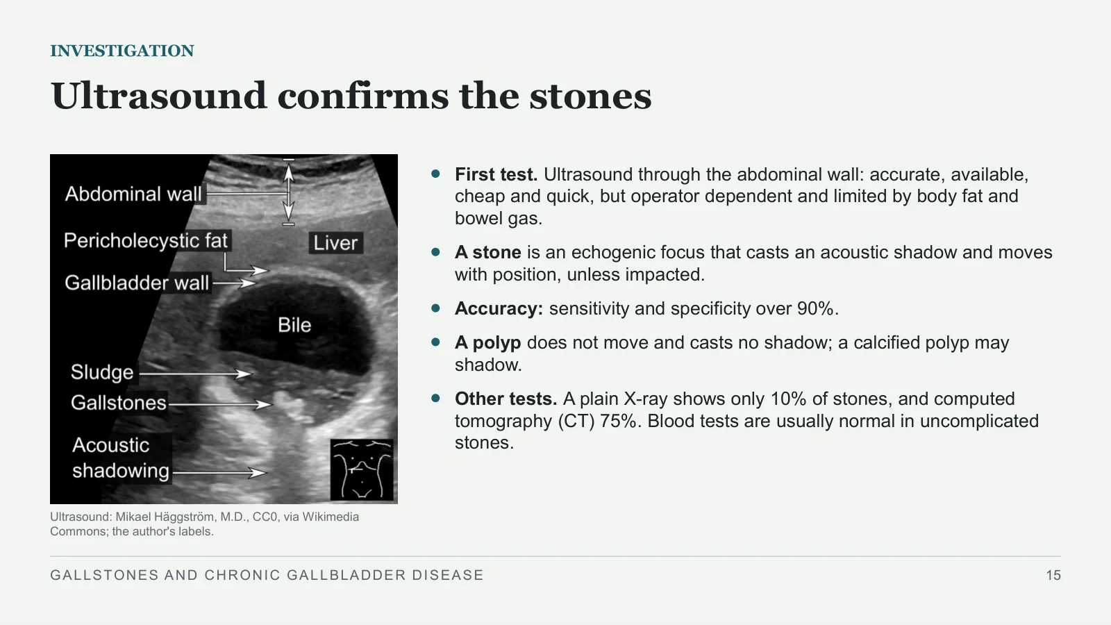 Slide 15: Ultrasound confirms the stones