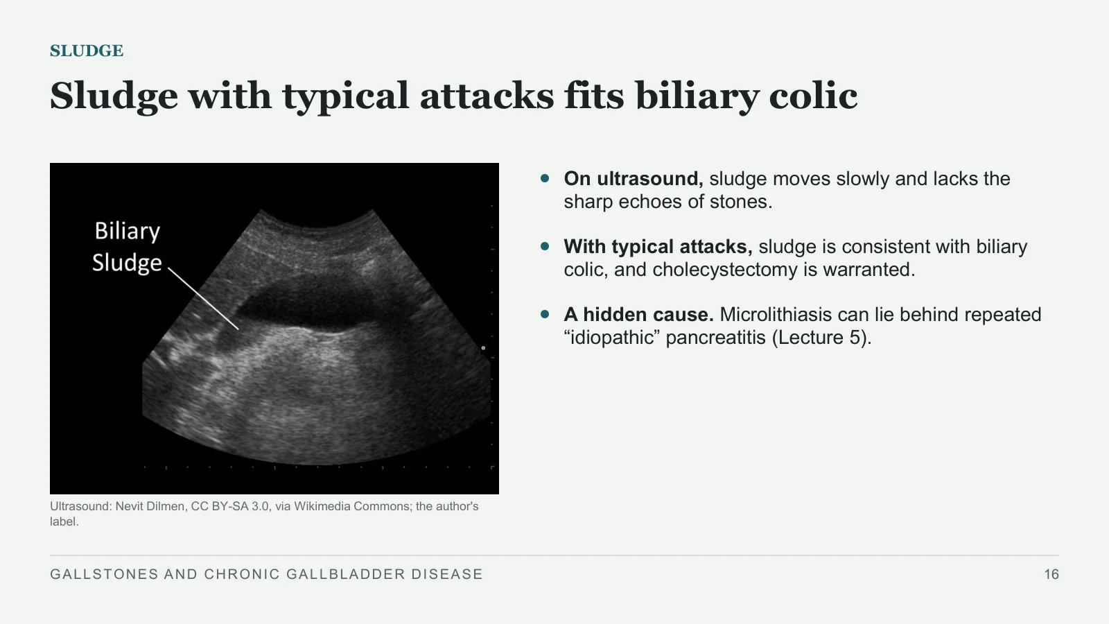 Slide 16: Sludge with typical attacks fits biliary colic