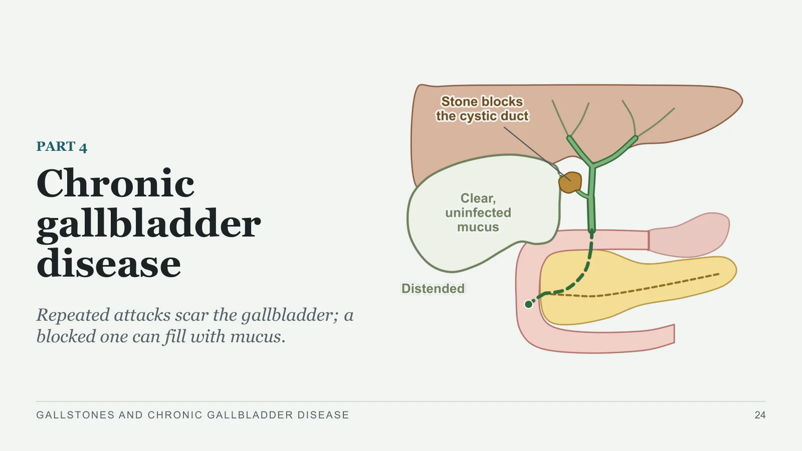 Slide 24: Chronic gallbladder disease