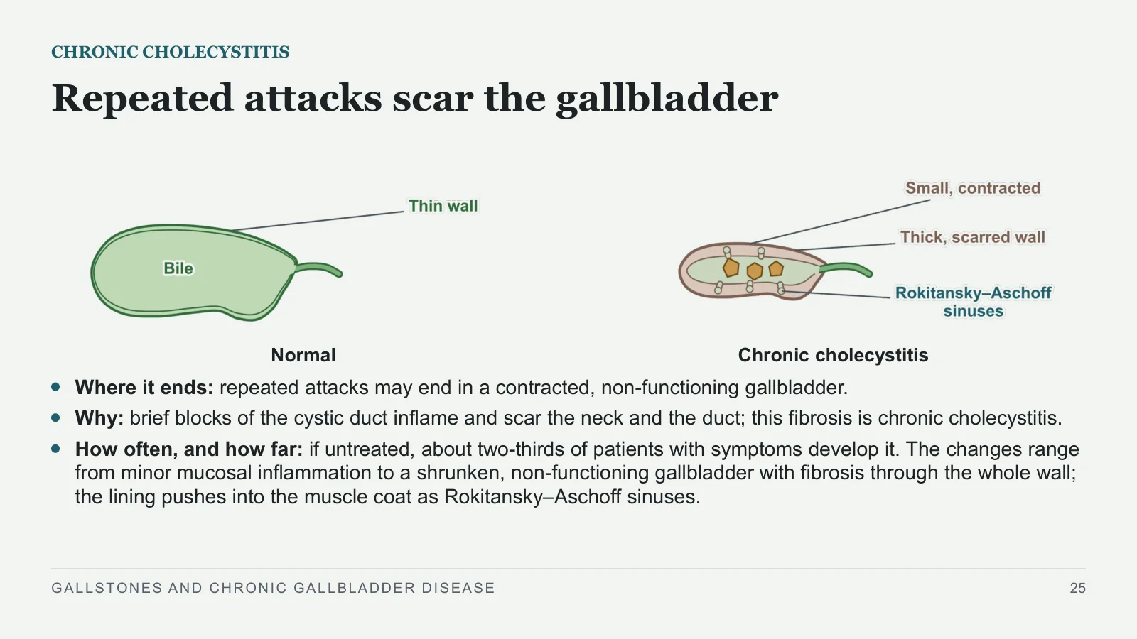 Slide 25: Repeated attacks scar the gallbladder