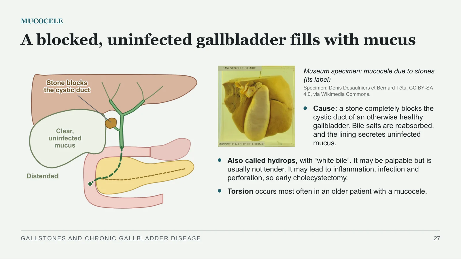 Slide 27: A blocked, uninfected gallbladder fills with mucus