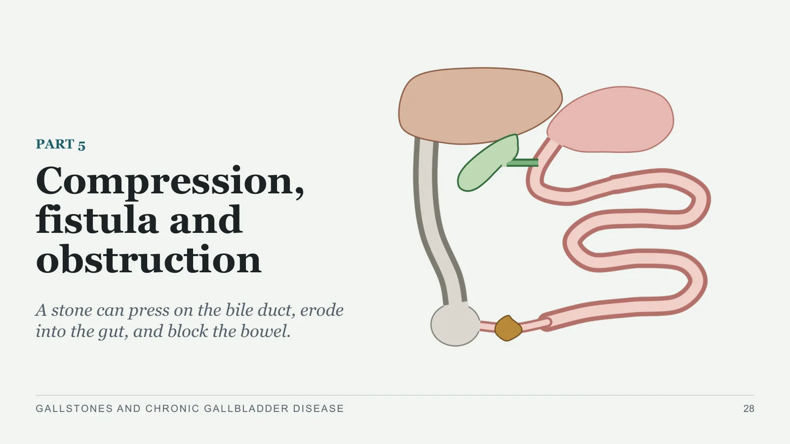 Slide 28: Compression, fistula and obstruction