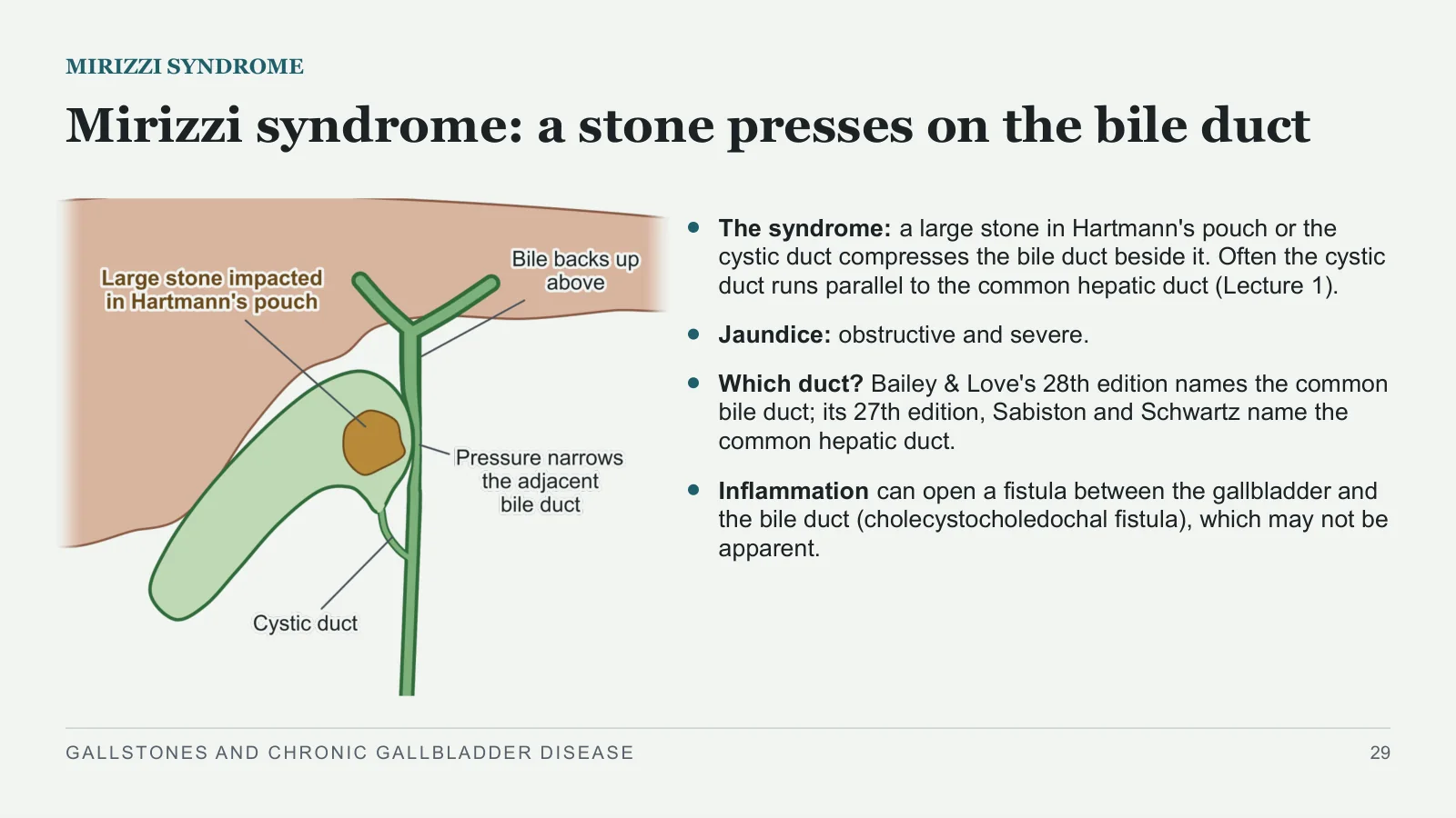 Slide 29: Mirizzi syndrome: a stone presses on the bile duct