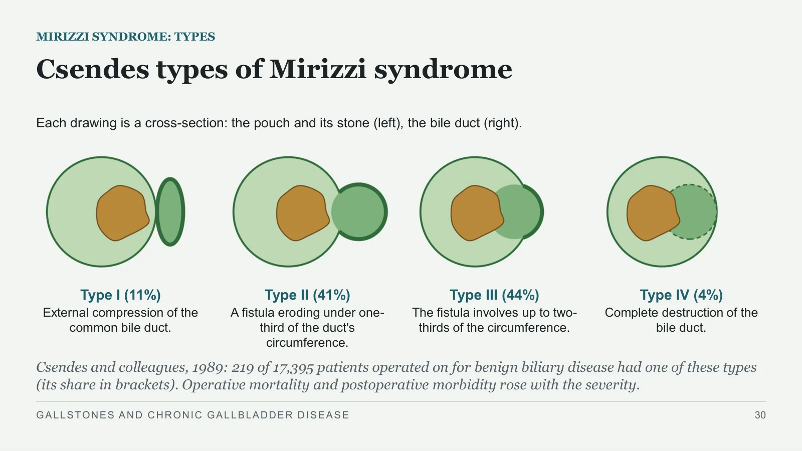 Slide 30: Csendes types of Mirizzi syndrome