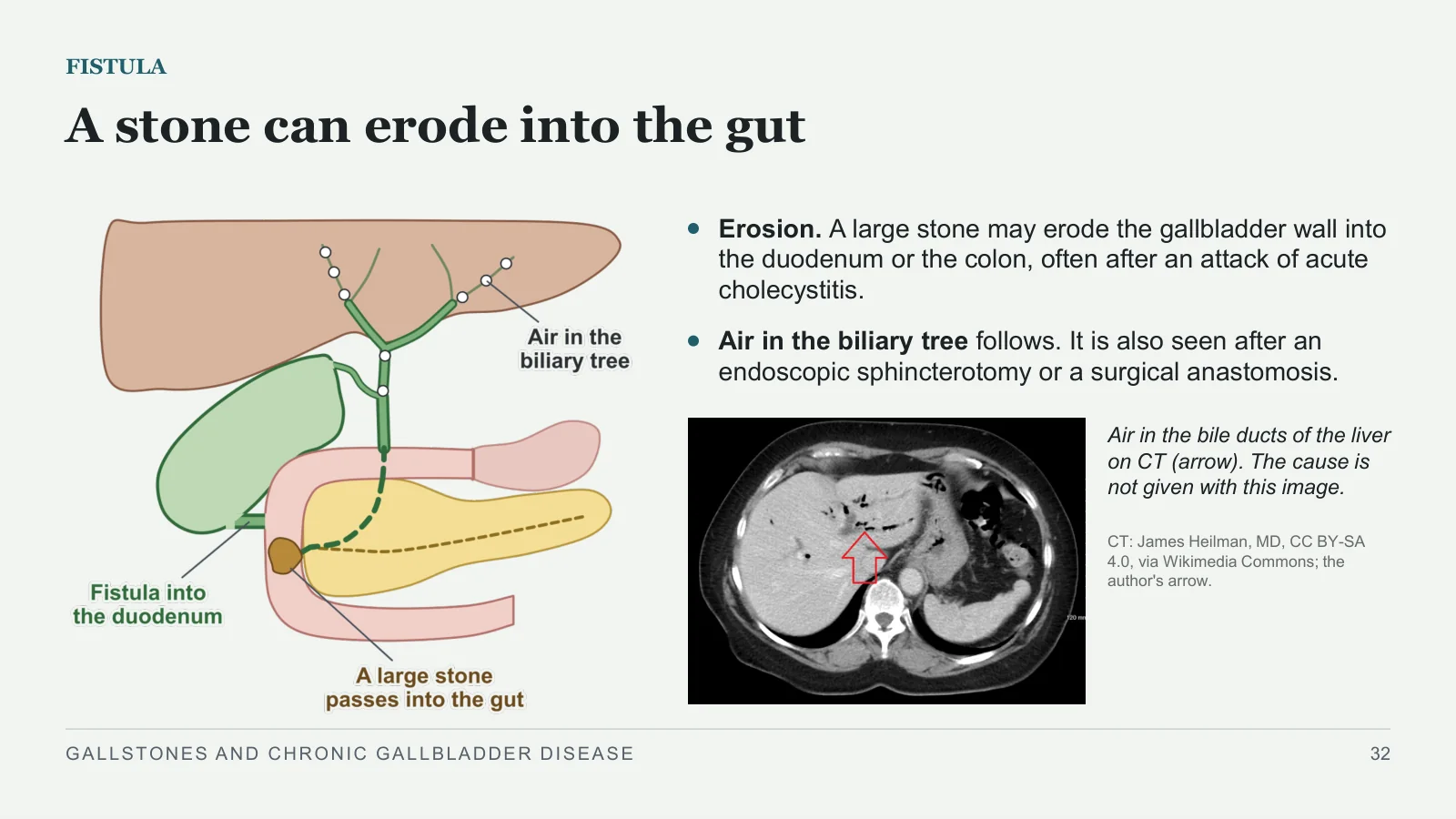 Slide 32: A stone can erode into the gut