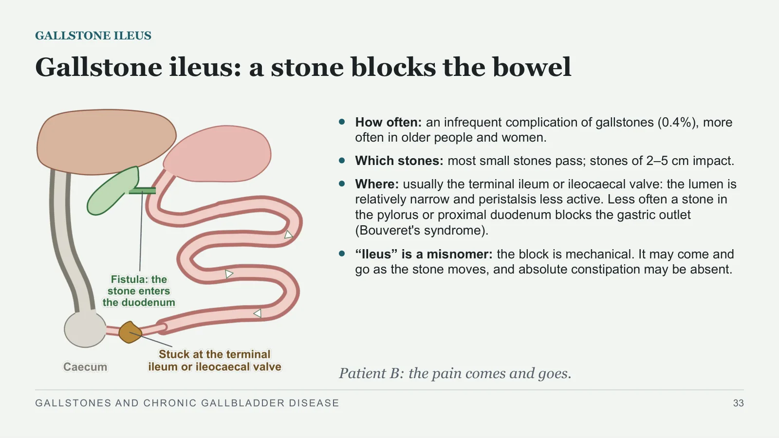 Slide 33: Gallstone ileus: a stone blocks the bowel