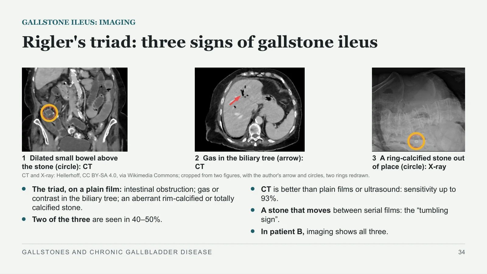 Slide 34: Rigler's triad: three signs of gallstone ileus