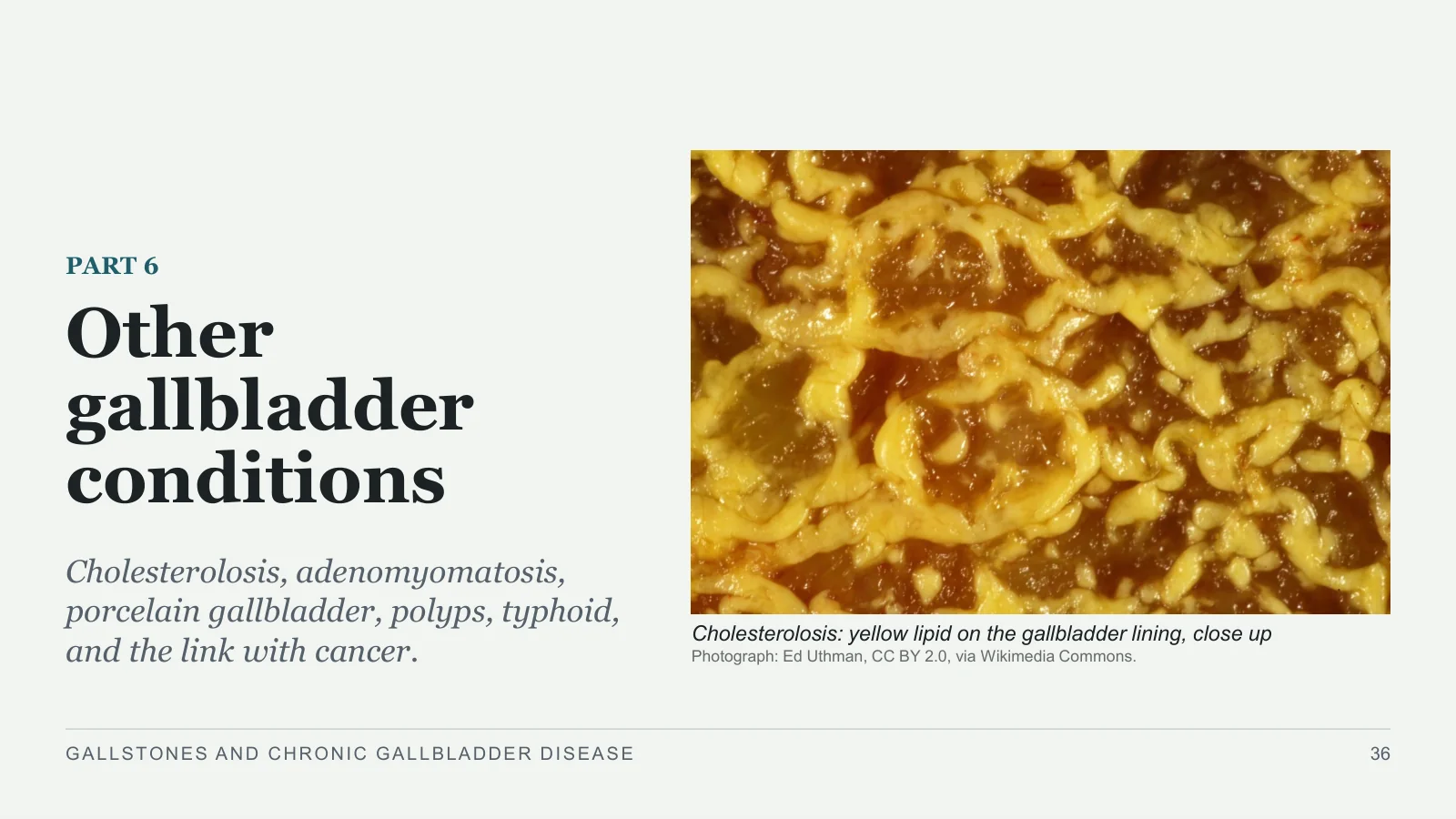 Slide 36: Other gallbladder conditions