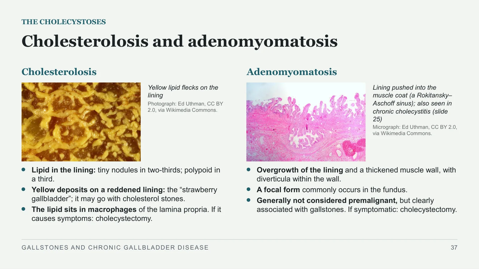 Slide 37: Cholesterolosis and adenomyomatosis