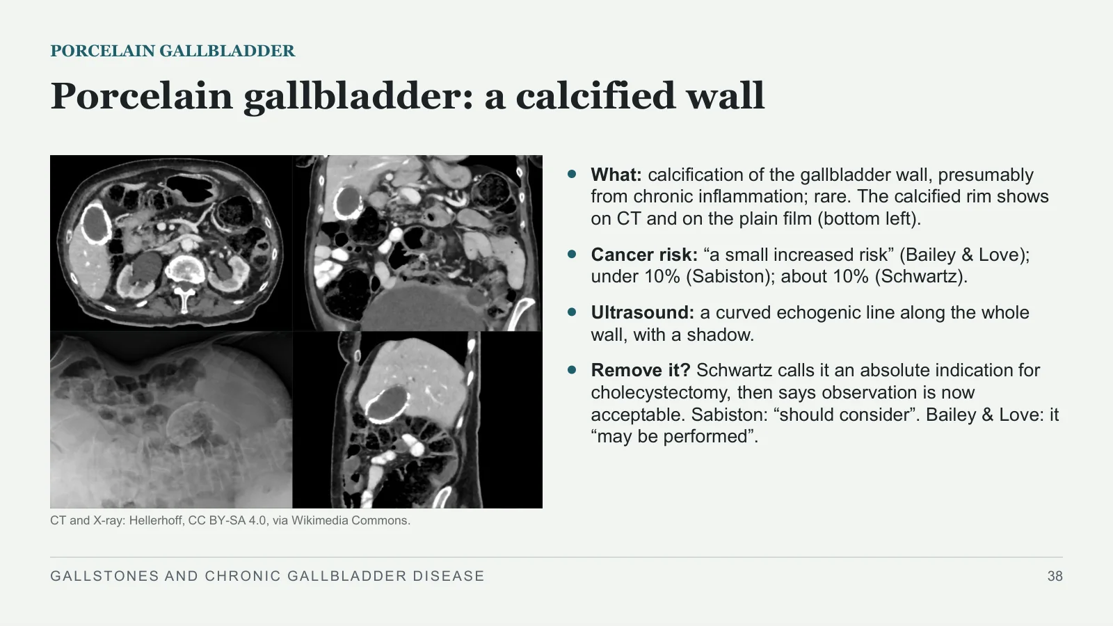 Slide 38: Porcelain gallbladder: a calcified wall