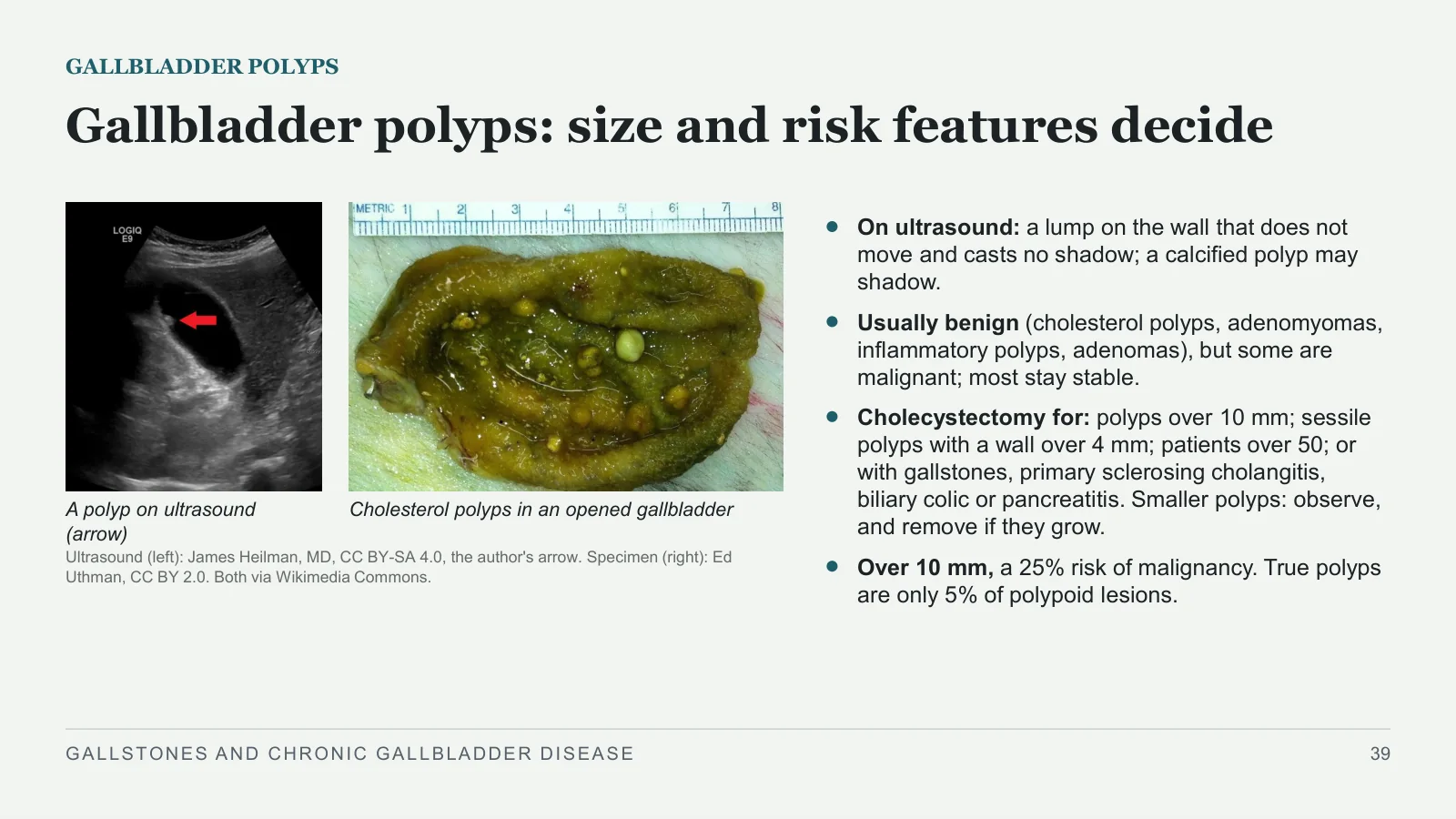 Slide 39: Gallbladder polyps: size and risk features decide