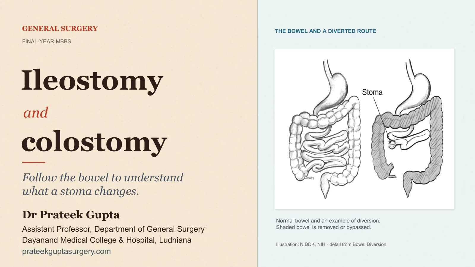 Slide 1: Ileostomy and Colostomy
