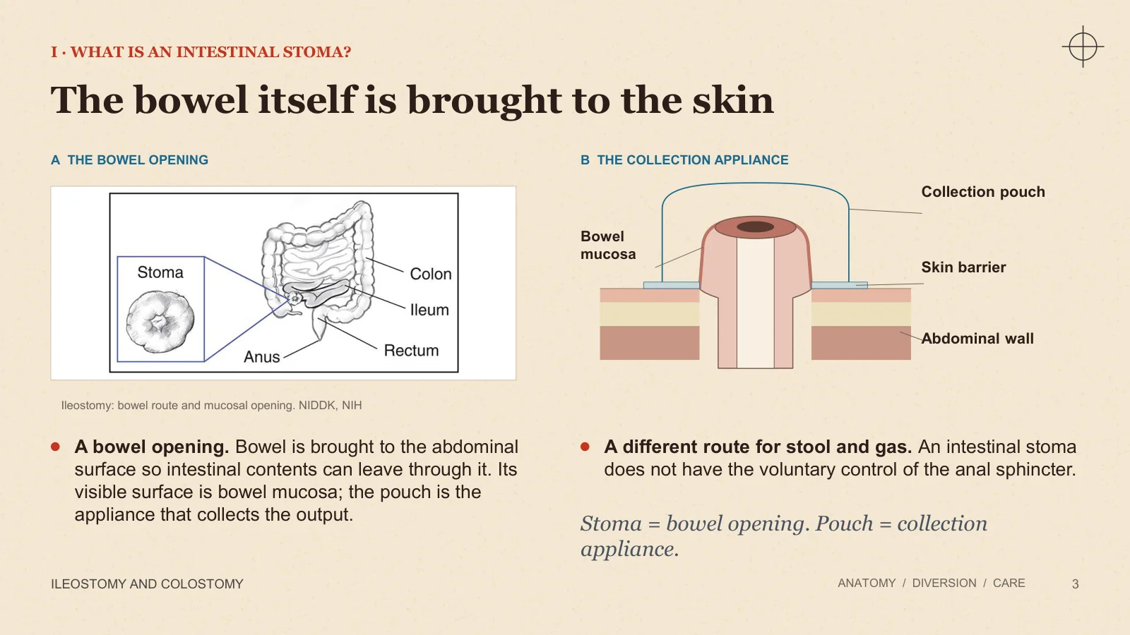 Slide 3: The bowel itself is brought to the skin