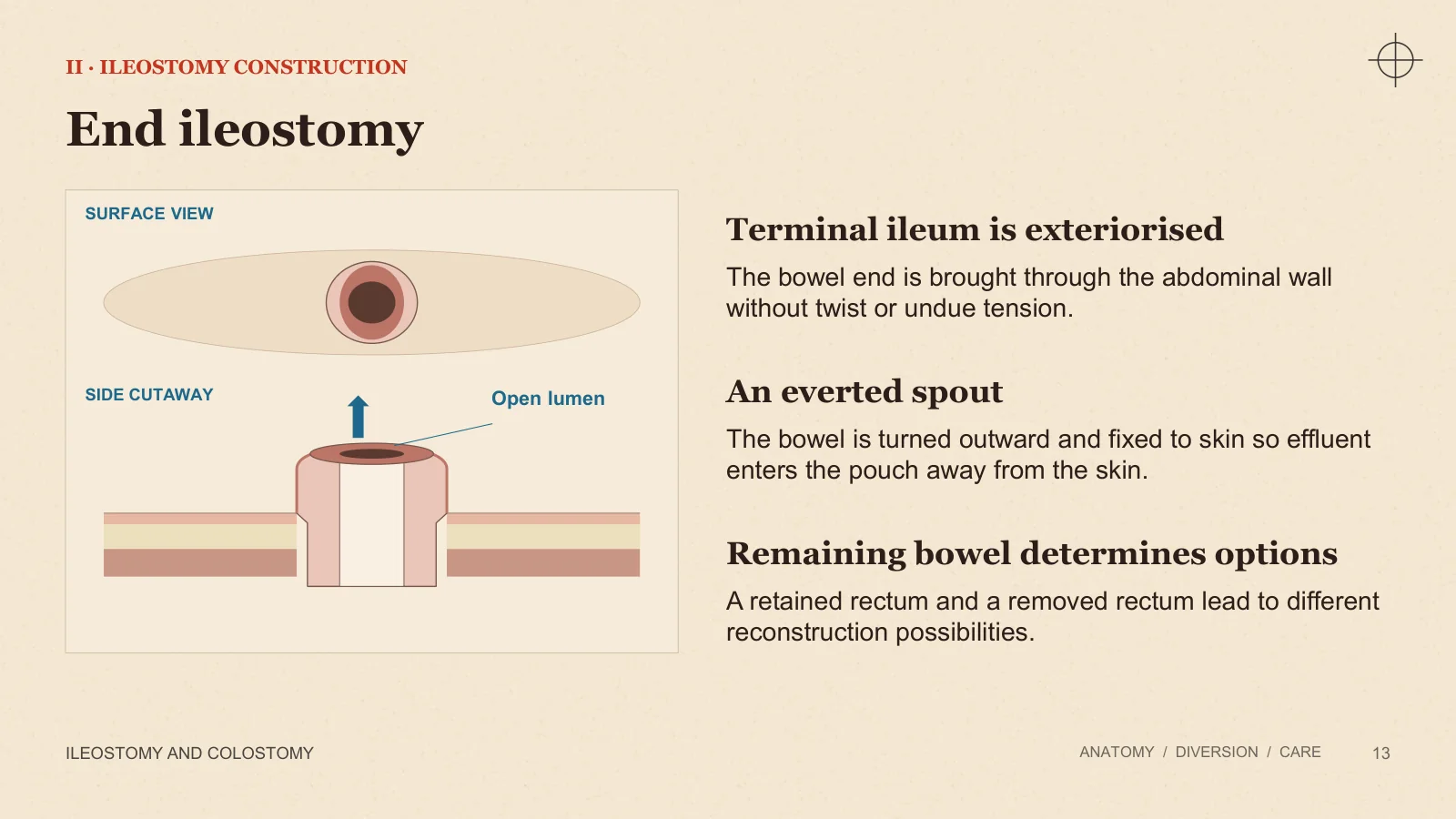 Slide 13: End ileostomy