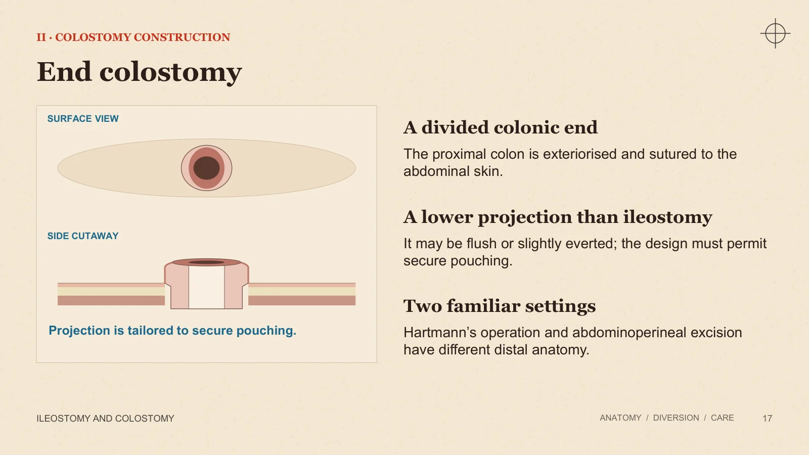 Slide 17: End colostomy