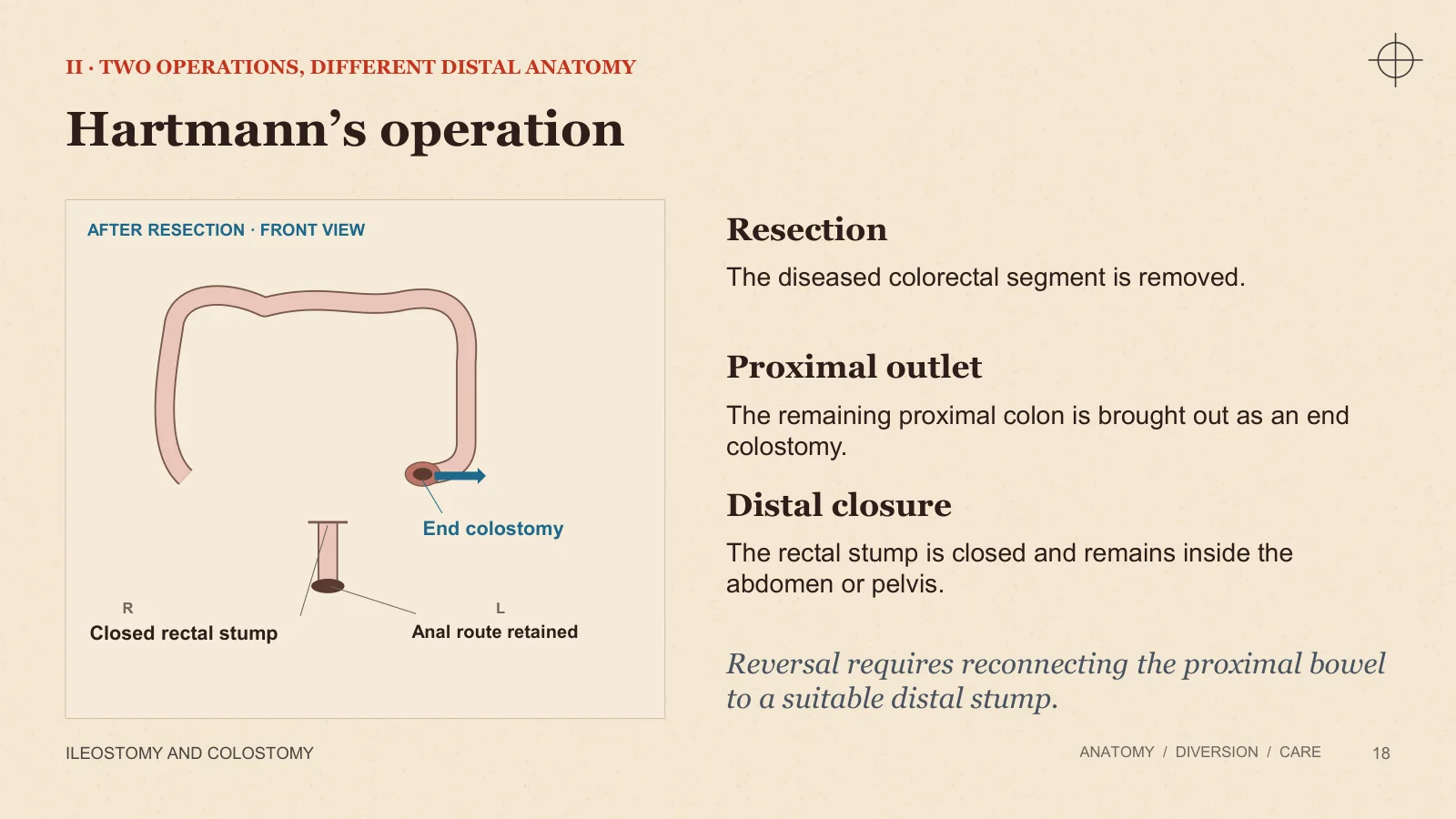 Slide 18: Hartmann’s operation