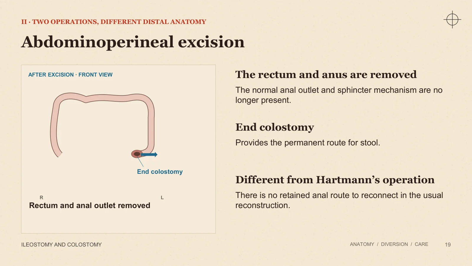 Slide 19: Abdominoperineal excision