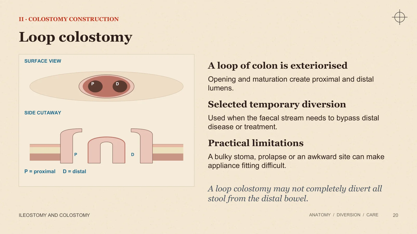 Slide 20: Loop colostomy