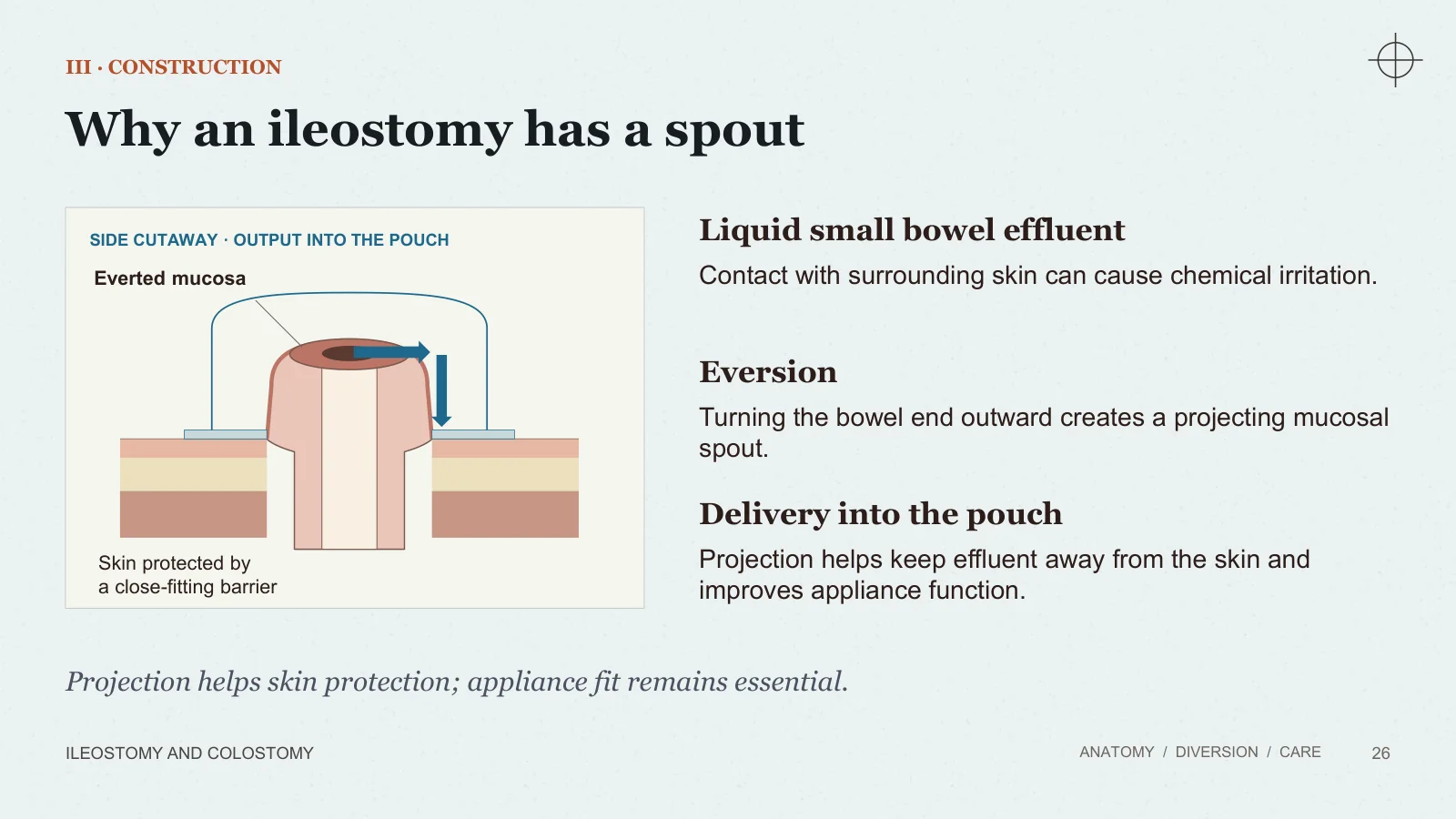 Slide 26: Why an ileostomy has a spout