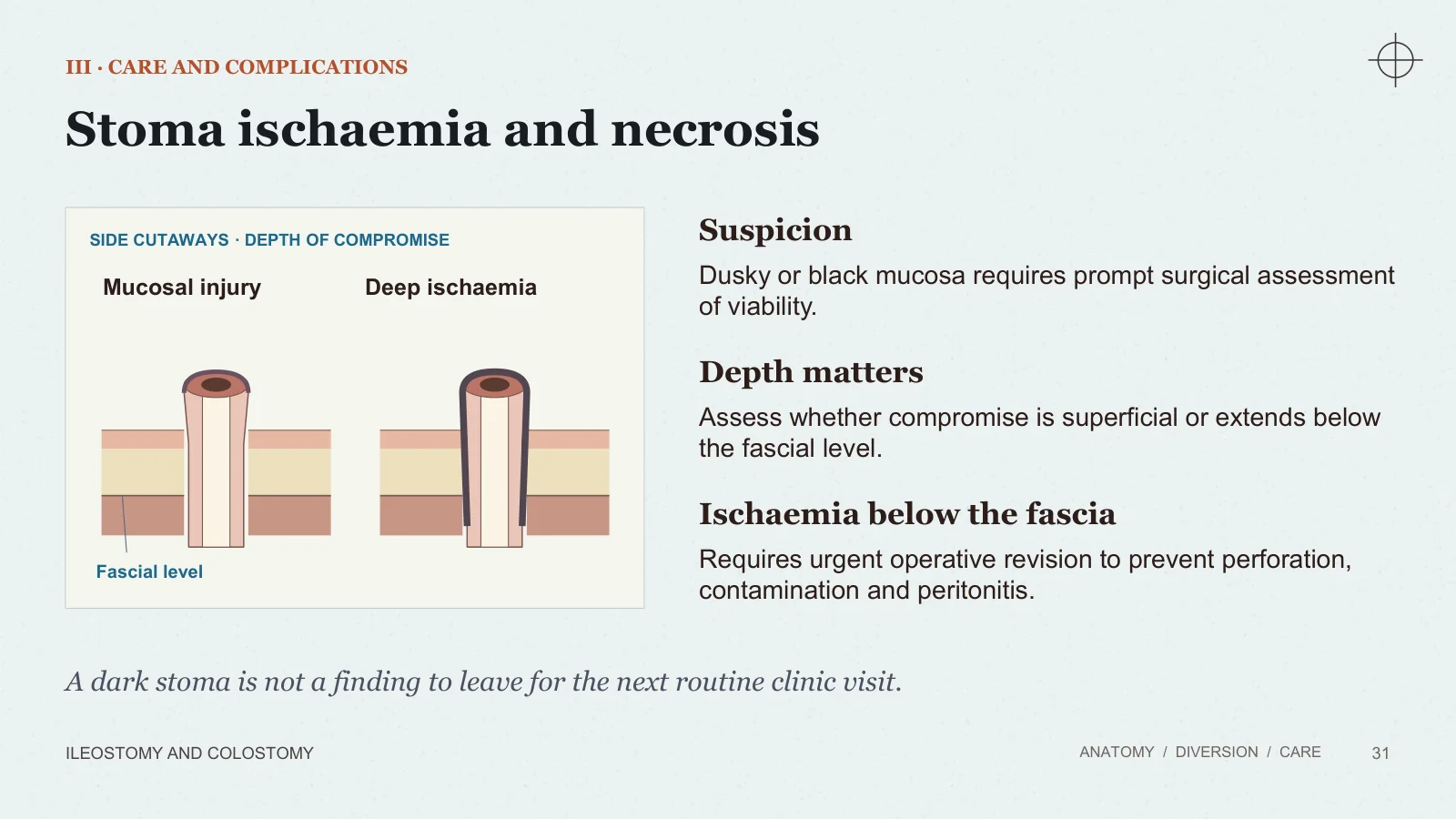 Slide 31: Stoma ischaemia and necrosis