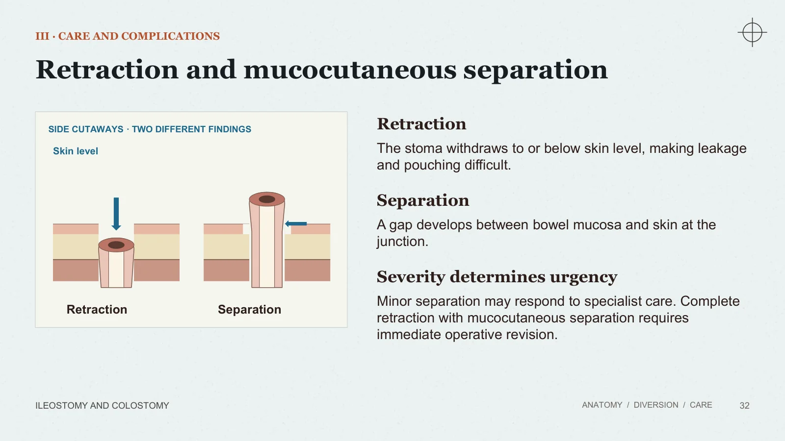 Slide 32: Retraction and mucocutaneous separation