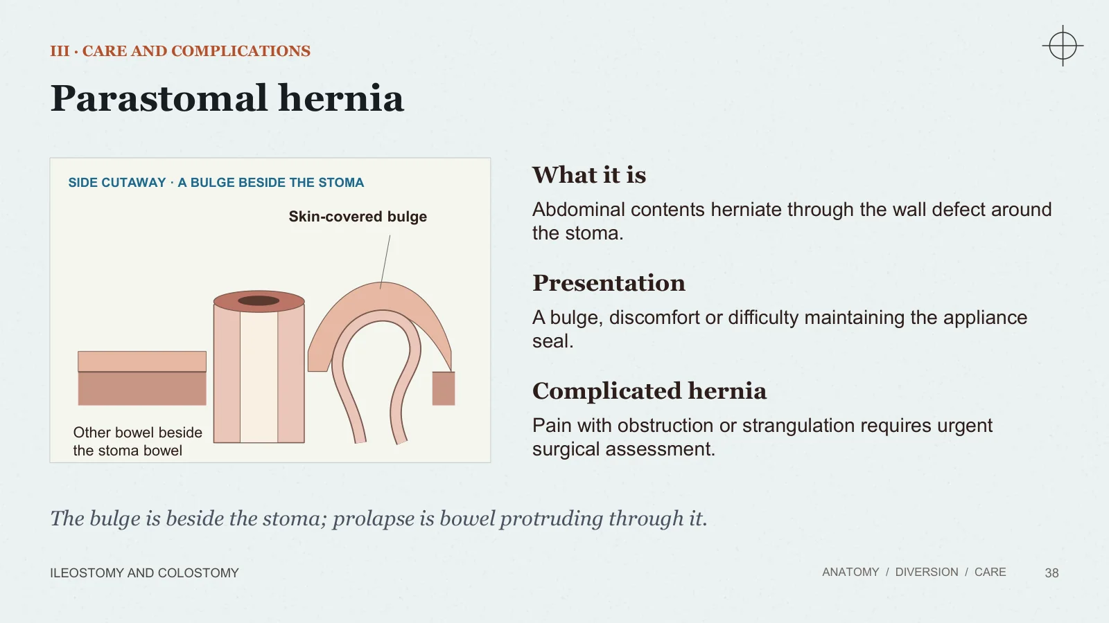 Slide 38: Parastomal hernia