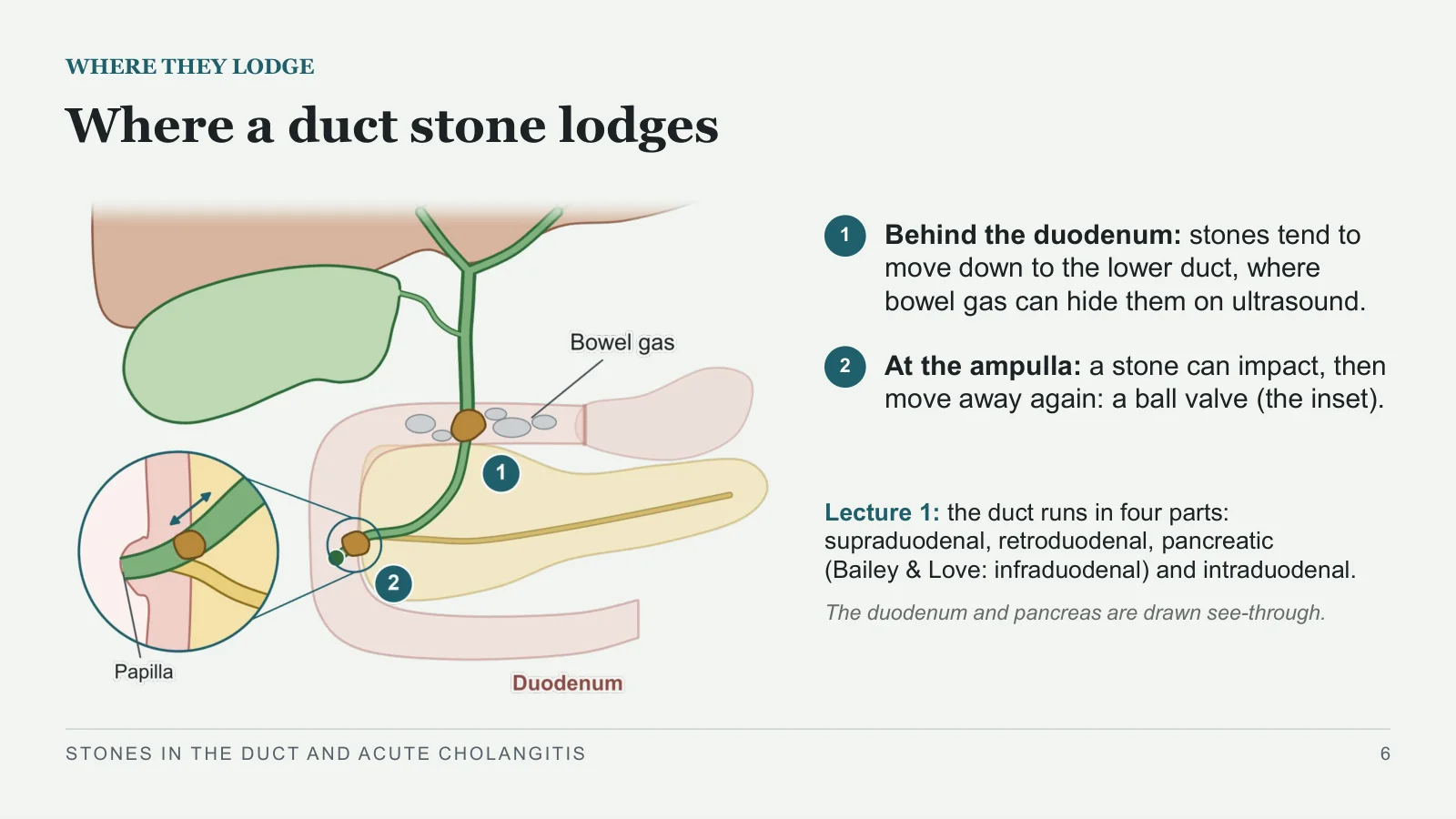 Slide 6: Where a duct stone lodges