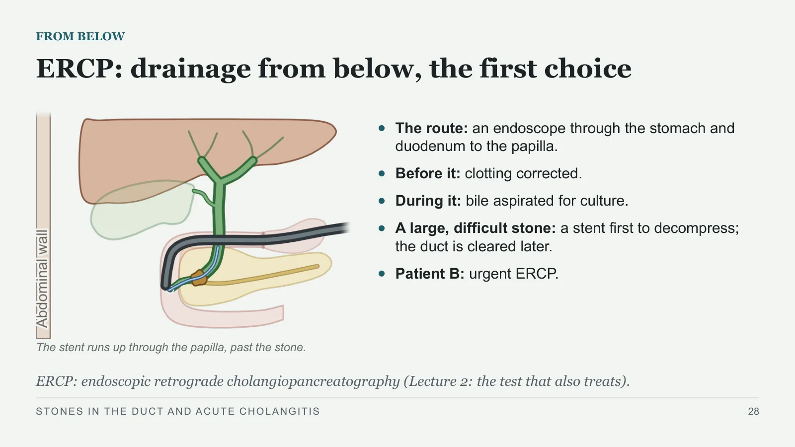 Slide 28: ERCP: drainage from below, the first choice