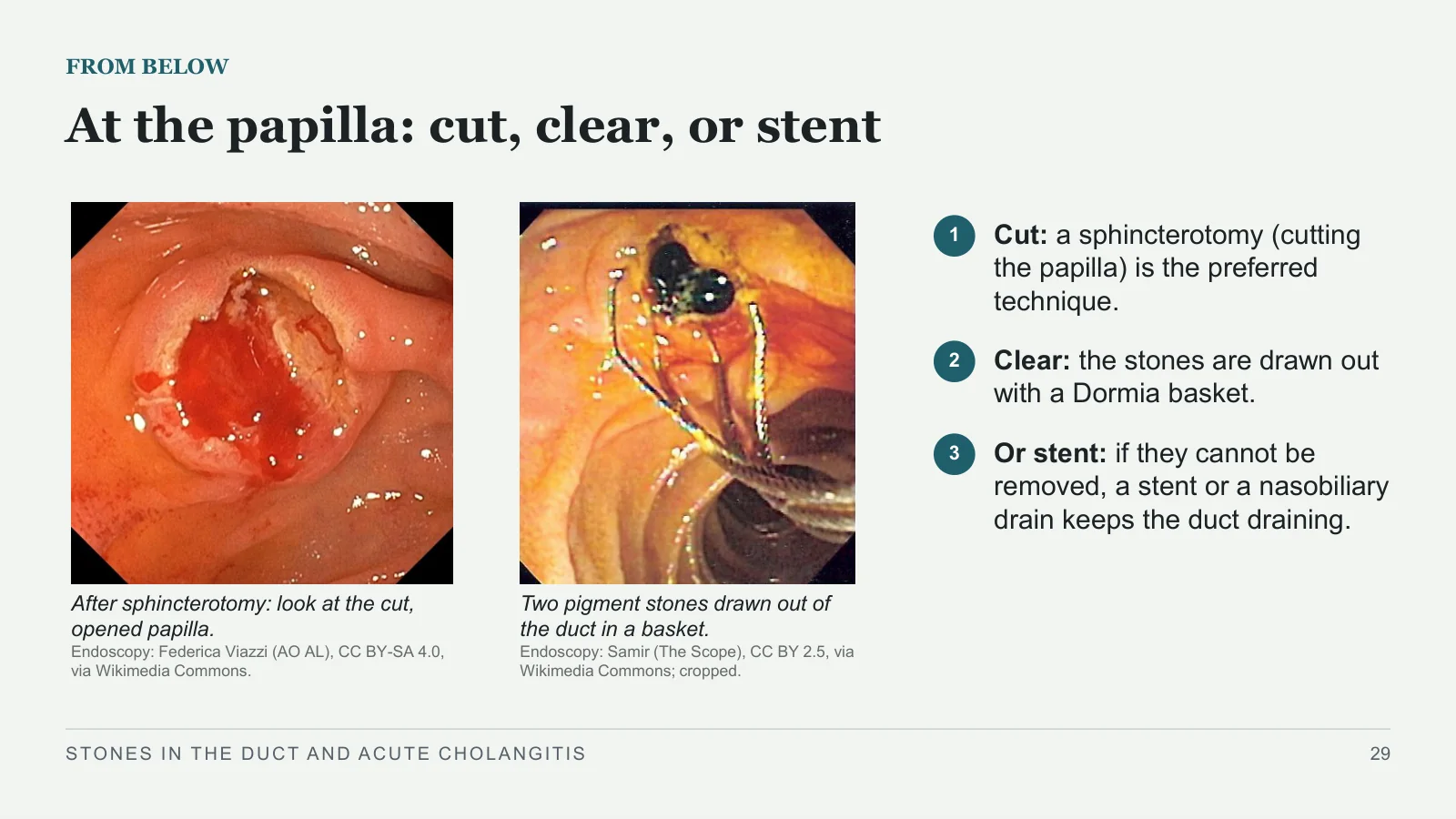 Slide 29: At the papilla: cut, clear, or stent
